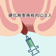 内痔核硬化療法剤(ジオン)による治療